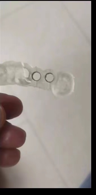 Guide de plantation d'impriman - Dental 3D Printer Resin avis et prix