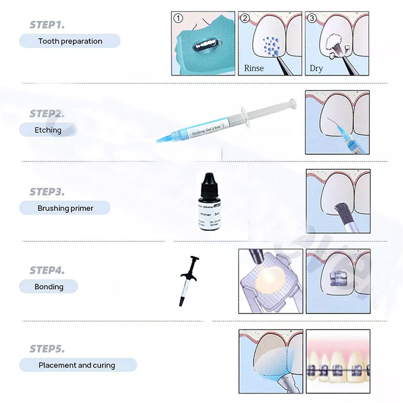 Kit d'adhésifs orthodontiques  - Dental Impression Material Kit avis et prix